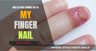 Nail Mystery: Why Is Pus Emerging from My Finger?