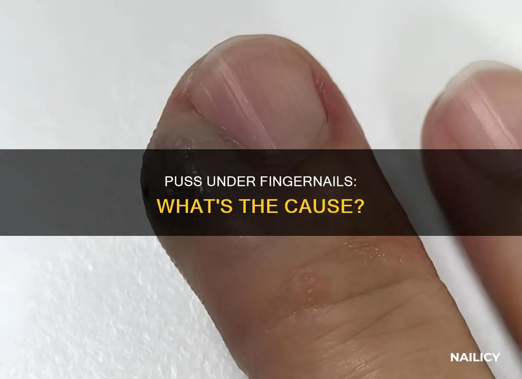 why is puss coming out of my finger nail