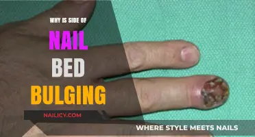 Why Is the Side of My Nail Bed Bulging? Causes Explained