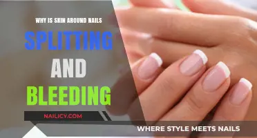 Why Your Skin Around Nails Splits and Bleeds: Causes and Solutions
