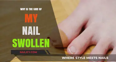 Swollen Nail Side: Causes, Symptoms, and Effective Treatment Options Explained