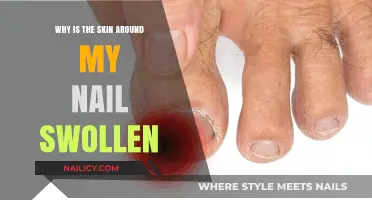 Swollen Skin Around Nails: Causes, Symptoms, and Effective Treatments