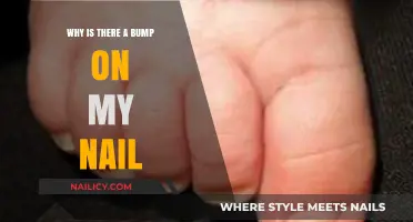 Bump on My Nail: Causes, Concerns, and When to Seek Help