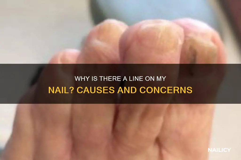 why is there a line on my nail