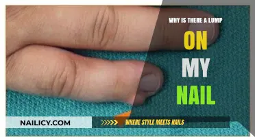 Lump on My Nail: Causes, Concerns, and When to Seek Help