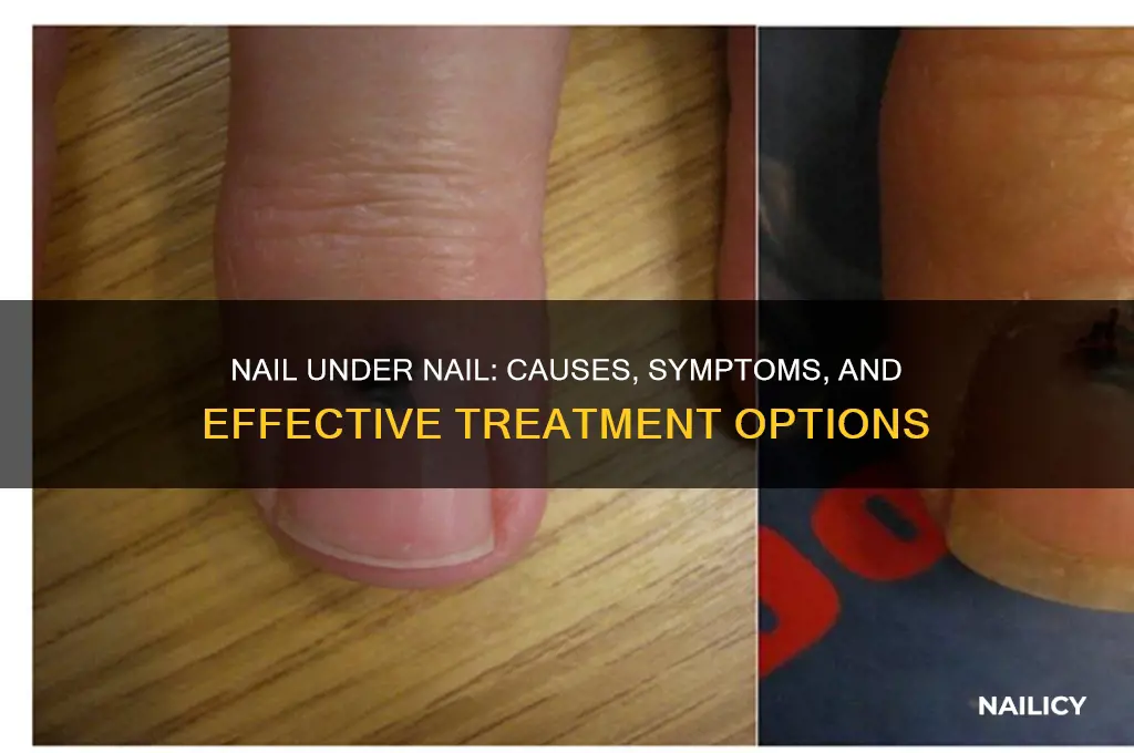 why is there a nail under my nail