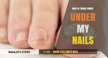 Why Does Crust Form Under Nails? Causes and Solutions Explained