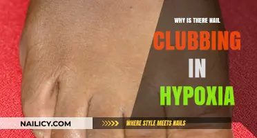 Understanding Nail Clubbing: Hypoxia's Silent Indicator and Its Causes