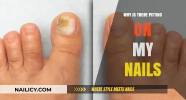 Pitting on Nails: Causes, Concerns, and Effective Solutions Explained
