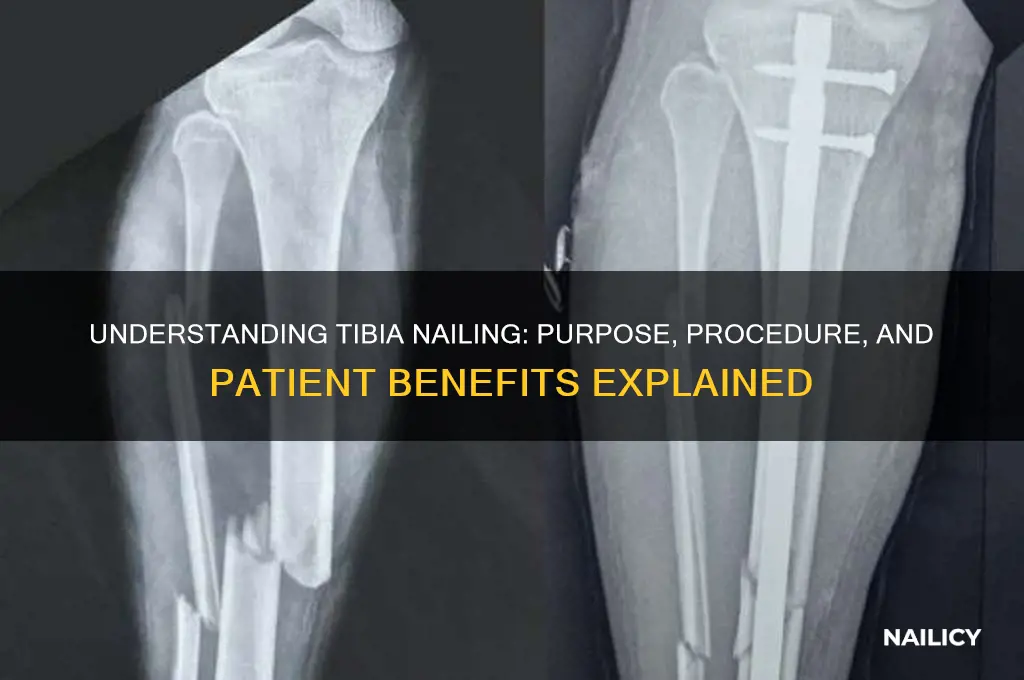 why is tibia nailing done