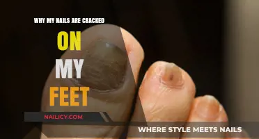 Why Are My Toenails Cracked? Causes and Solutions Explained