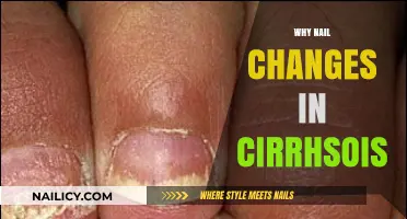 Understanding Nail Changes in Cirrhosis: Causes and Significance