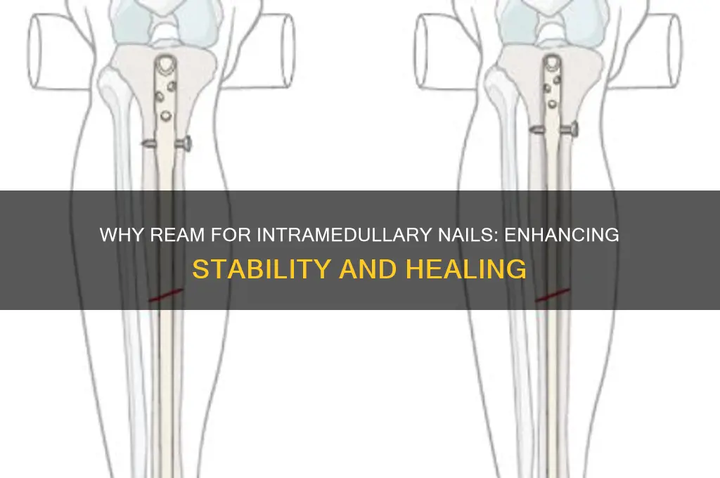 why ream for intramedullary nails