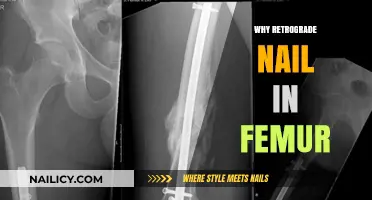 Understanding Retrograde Nailing in Femur Fractures: Benefits and Applications
