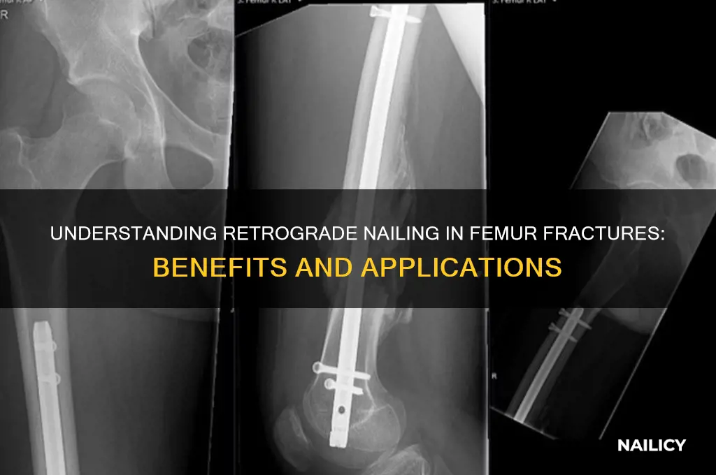 why retrograde nail in femur