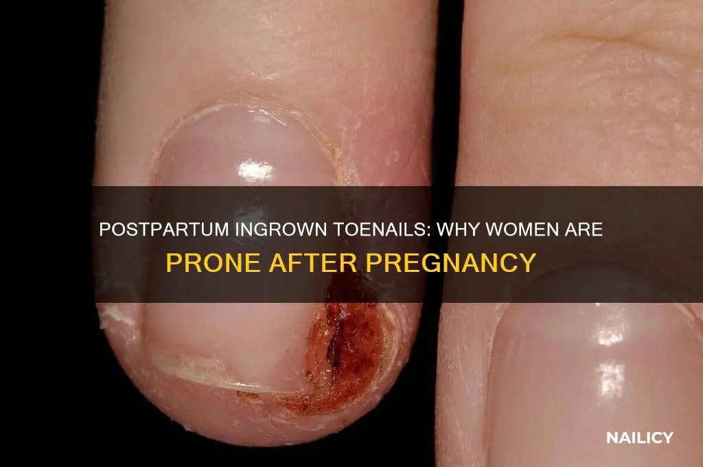 why women have ingrow tow nail after pregnancy