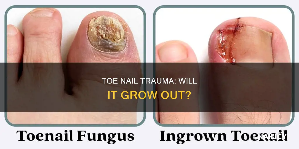 will a bad toe nail grow out