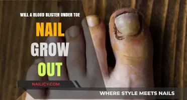 Blood Blister Under Toenail: Can You Grow It Out?