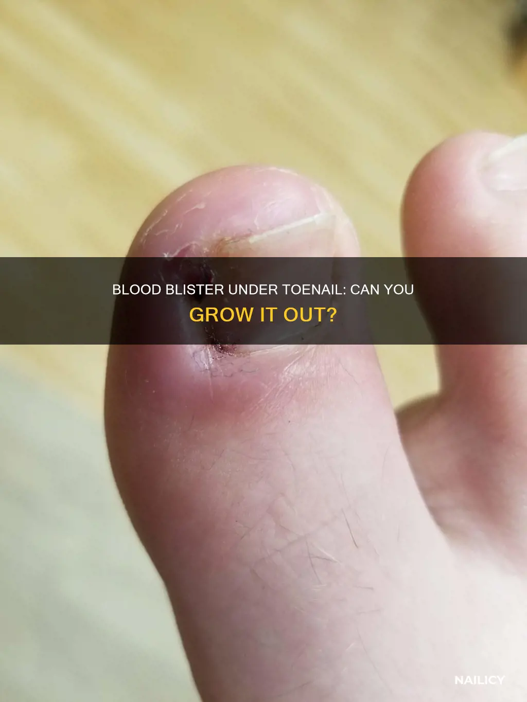 will a blood blister under toe nail grow out