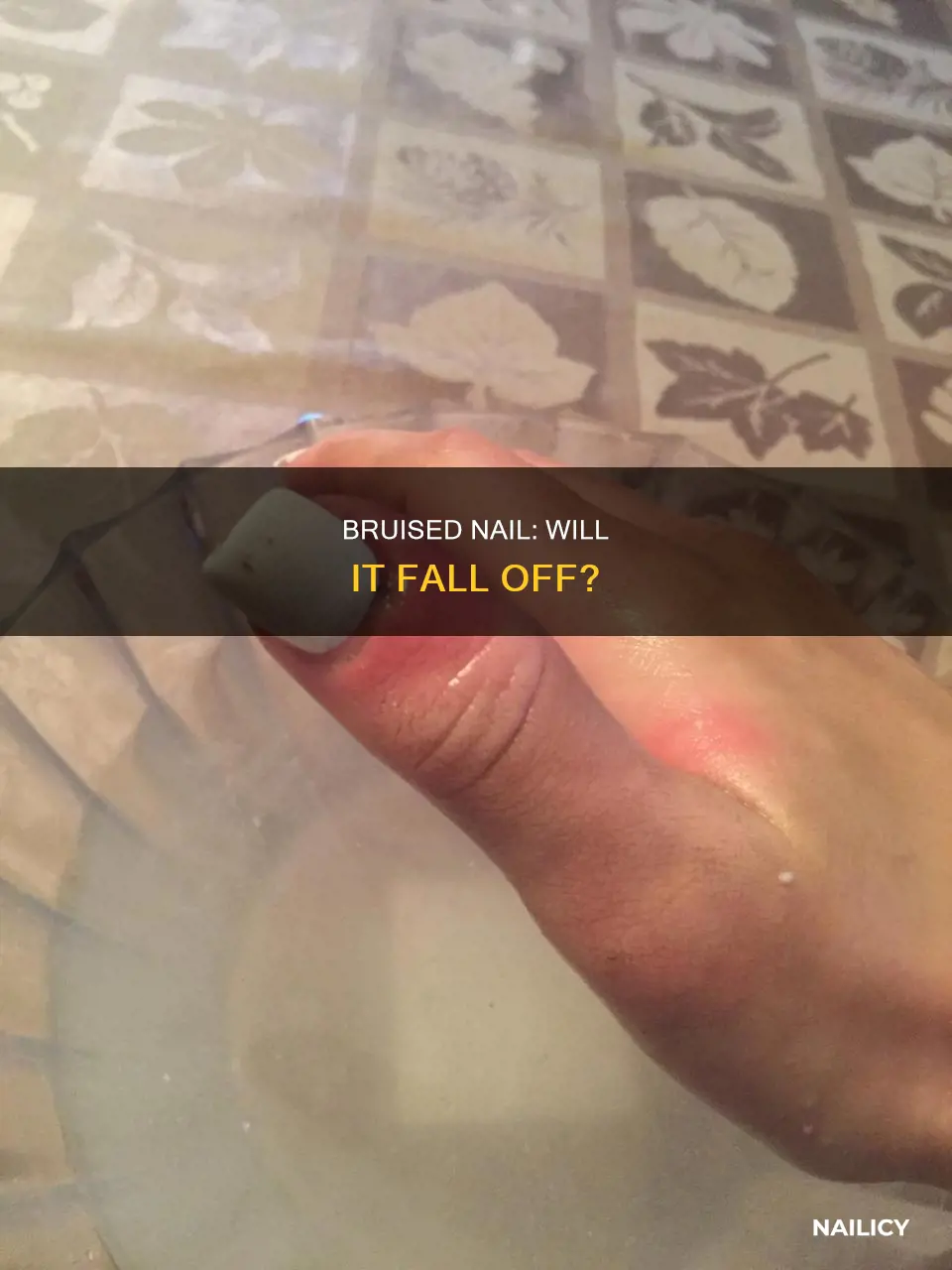 will a bruised finger nail fall off