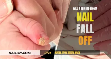 Bruised Fingernail: Will It Fall Off?