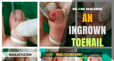 Toenail Trauma: Can Nail Salons Fix Ingrown Nails?