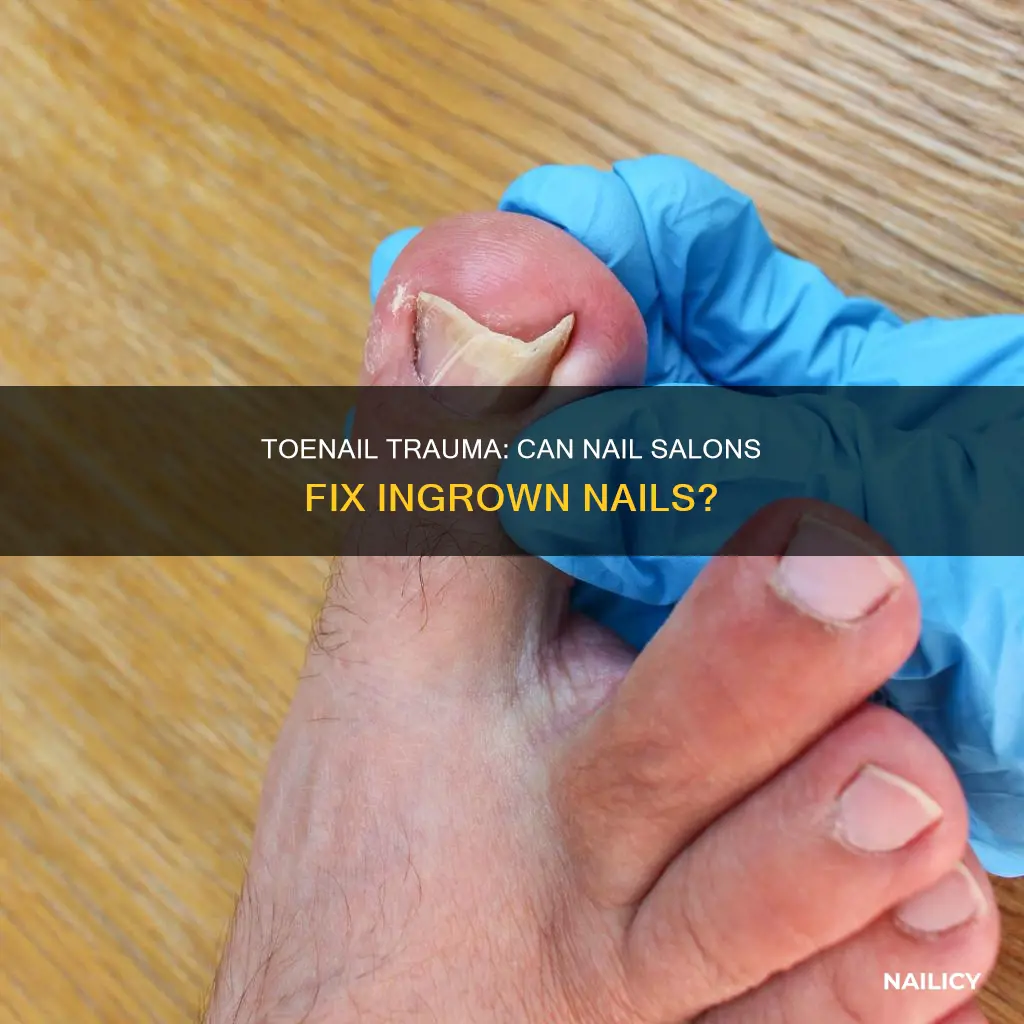 will a nail salon remove an ingrown toenail