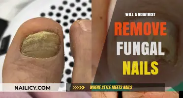 How Podiatrists Treat Fungal Nail Infections