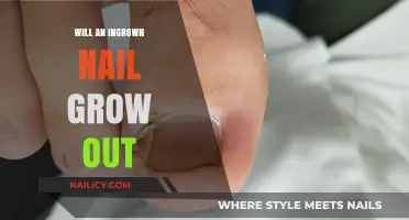 Ingrown Nails: Can They Grow Out?