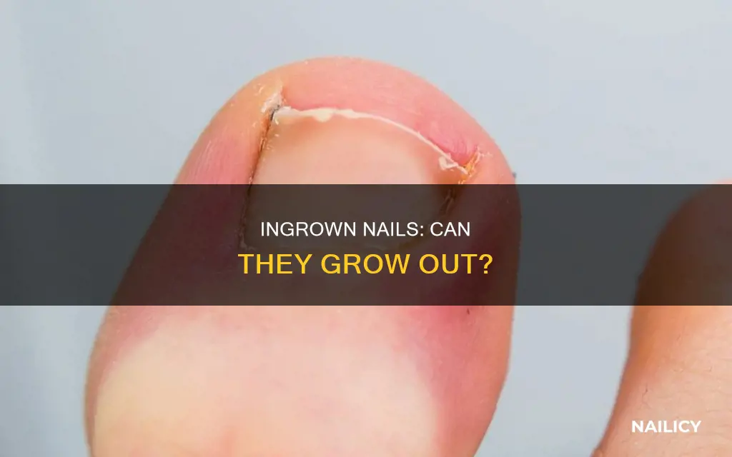 will an ingrown nail grow out