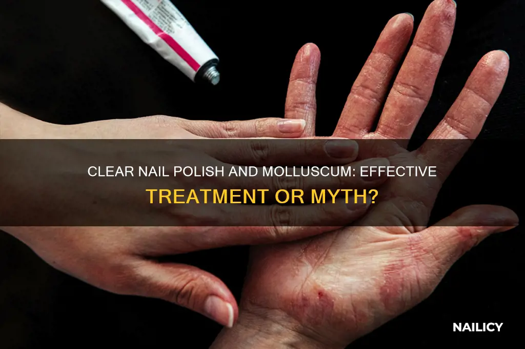 will clear nail polish kill molluscum