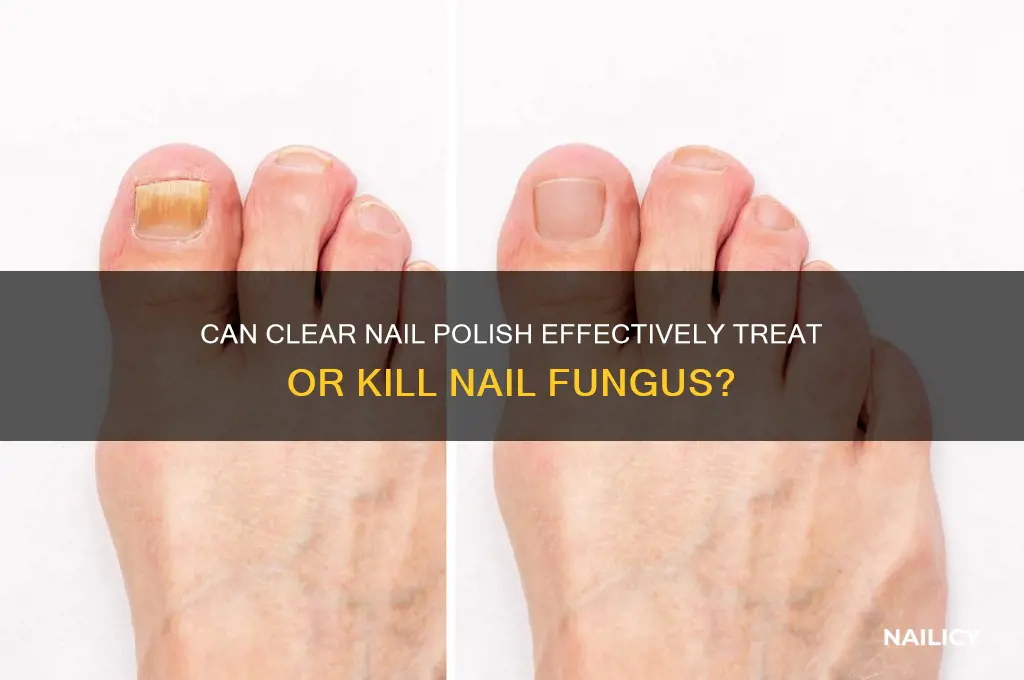 will clear nail polish kill nail fungus