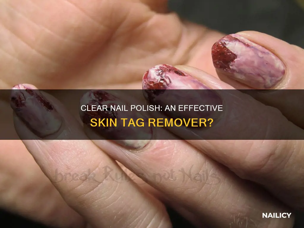 will clear nail polish remove skin tags