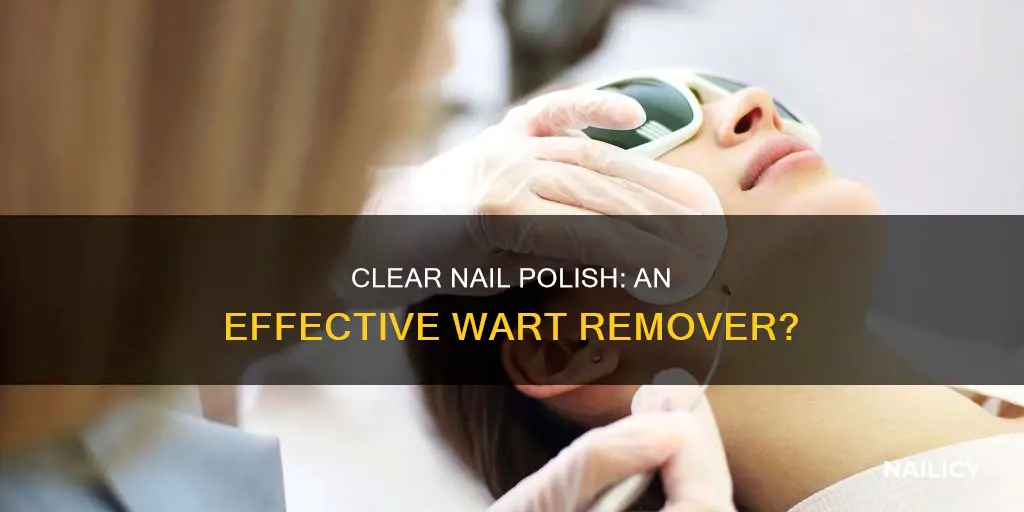 will clear nail polish remove warts