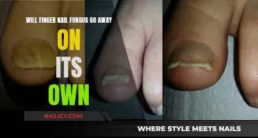 Fingernail Fungus: Can It Disappear Without Treatment?