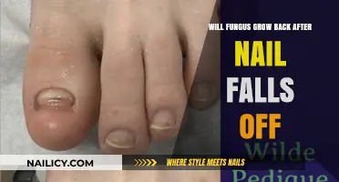 Fungus and Nail Loss: What to Expect