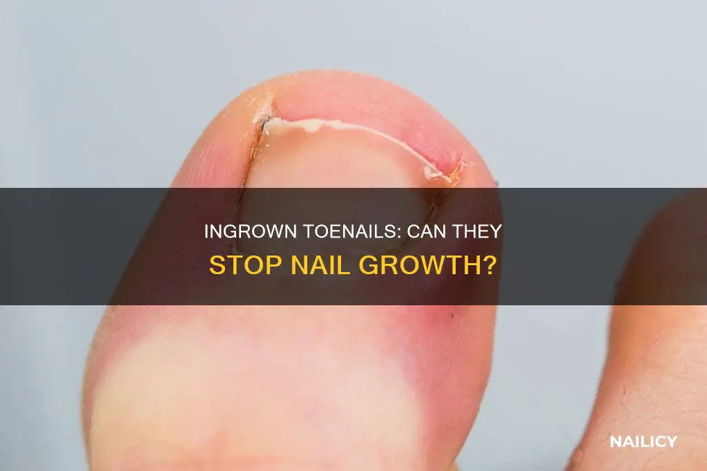 will ingrown toenails cause nail to not grow