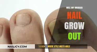 How Long Until My Bruised Nail Grows Out?