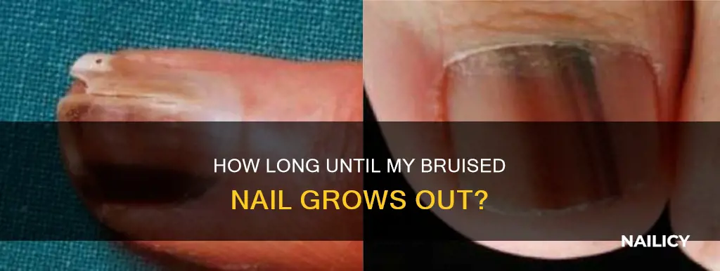 will my bruised nail grow out