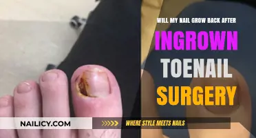 Ingrown Toenail Surgery: Will My Nail Grow Back?