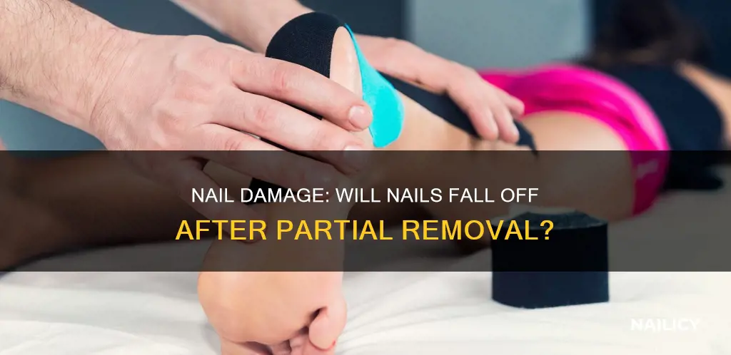 will nail fall off after parital removal