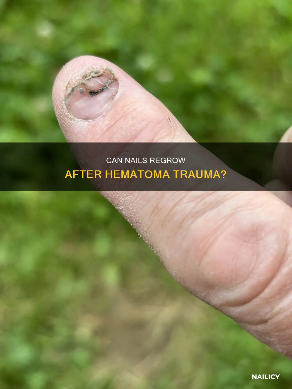 will nail grow back if hematoma at base