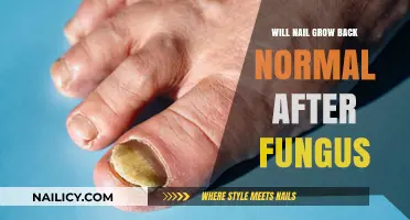 Nail Fungus: Can You Get Your Nails Back?