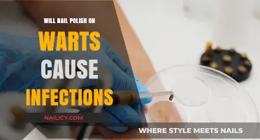 Nail Polish on Warts: Infection Risk or Safe Home Remedy?