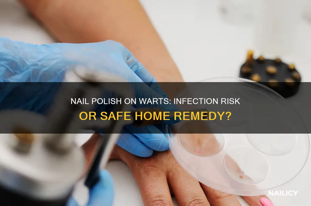 will nail polish on warts cause infections