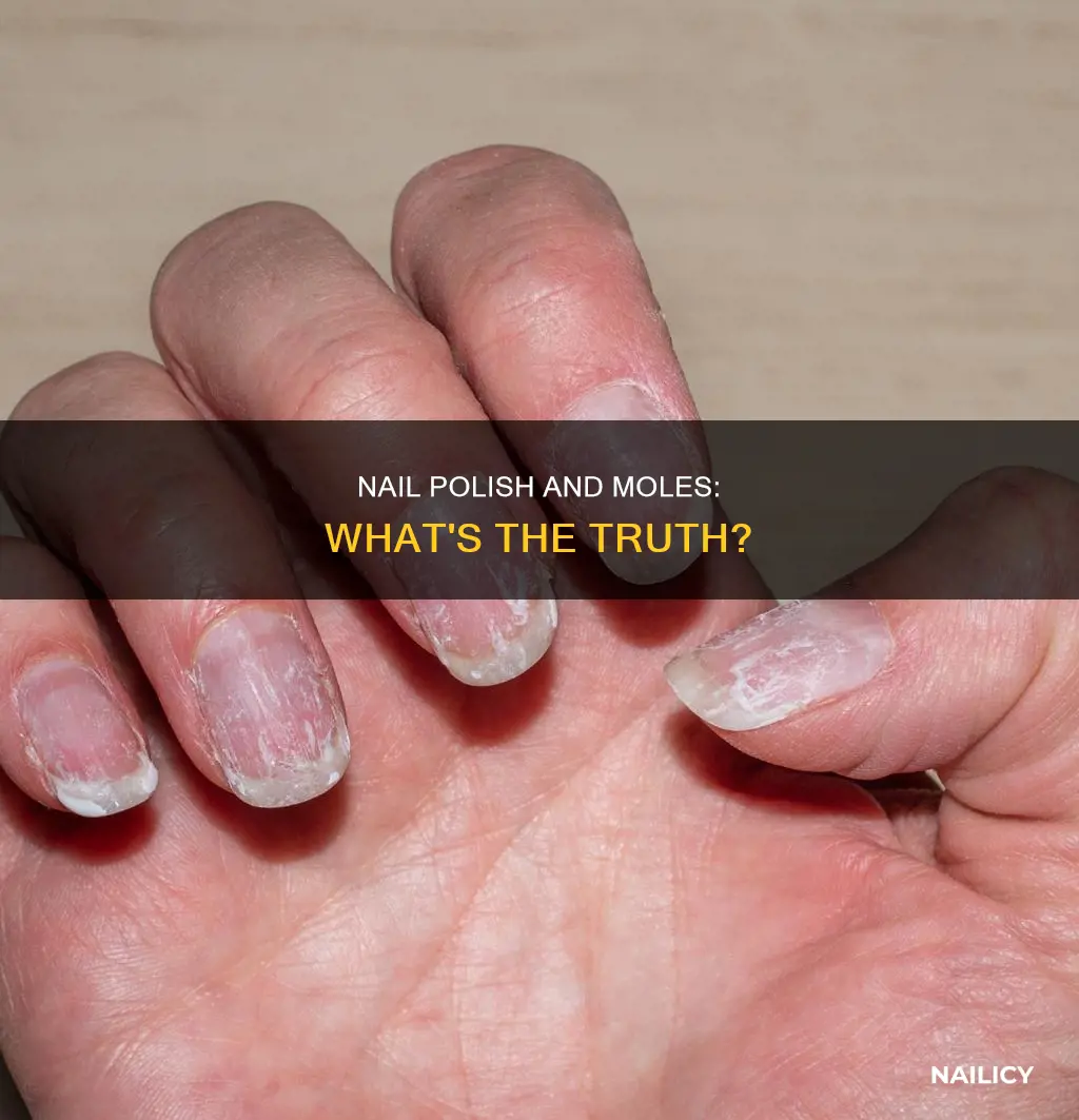 will nail polish remove moles