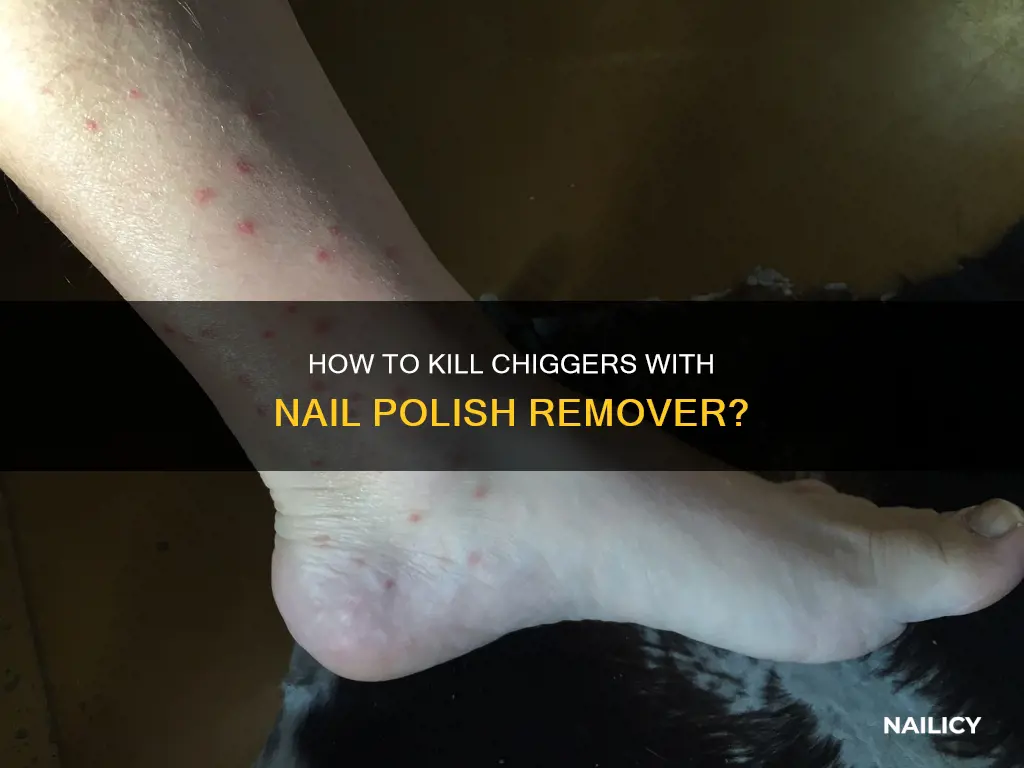 will nail polish remover kill chiggers