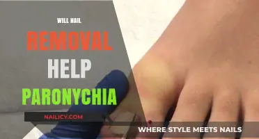 Treating Paronychia: Does Nail Removal Help?