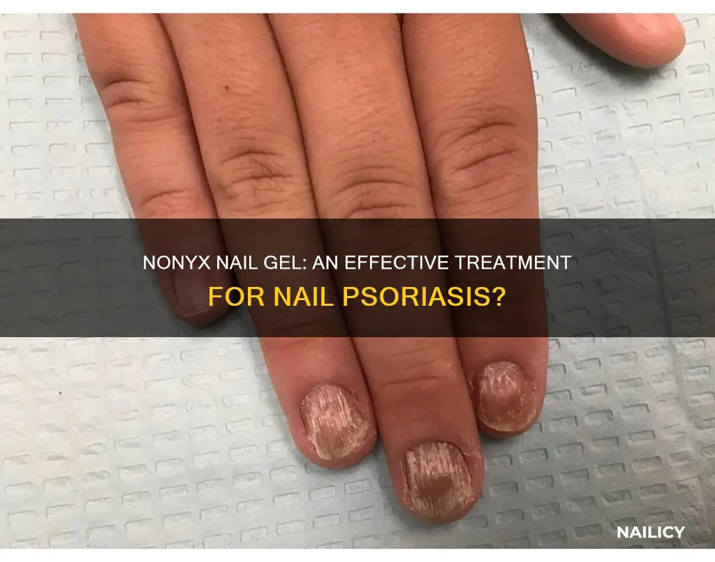 will nonyx nail gel help nail psoriasis