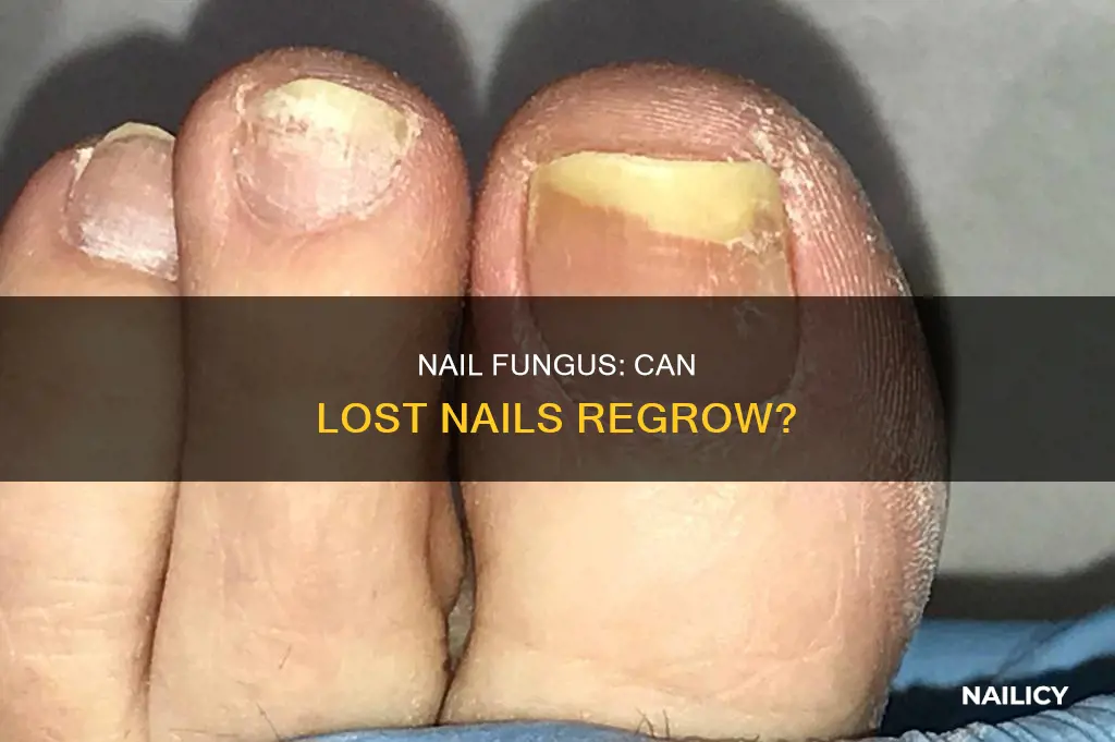 will the separated area from a nail fungus grow back